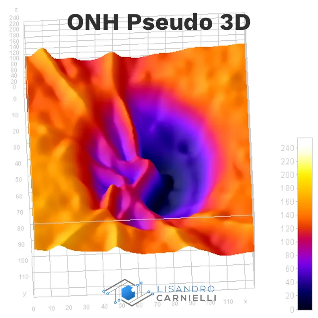 ONH Pseudo 3D Image